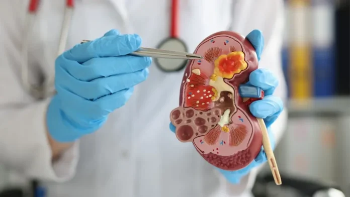 home remedies for kidney stones