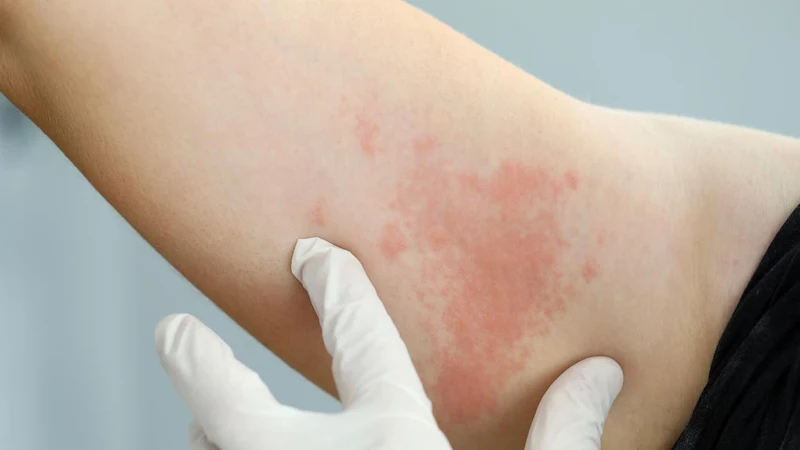 Recognizing Urticaria Symptoms