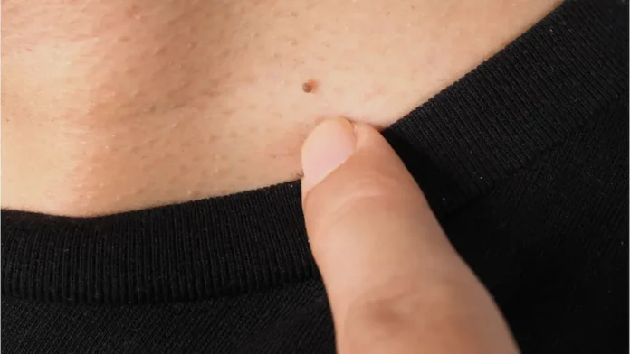 Remove warts on neck naturally