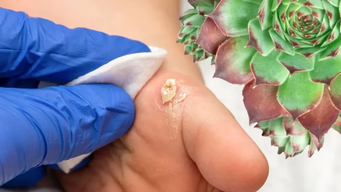 Remove corns on feet overnight
