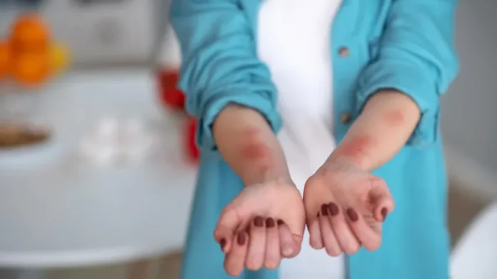 urticaria