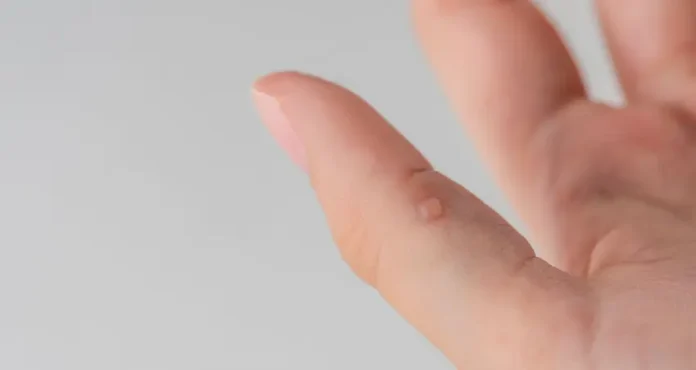 Warts on hands natural remedies