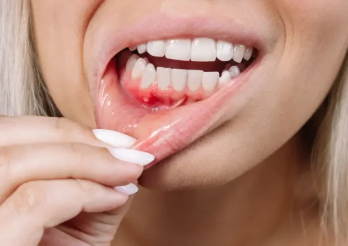 home remedies for receding gums